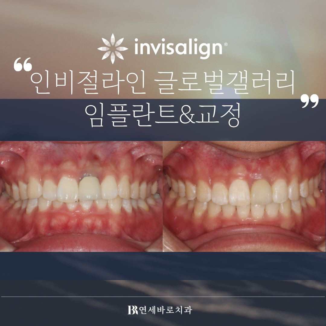 인천 인비절라인 글로벌 갤러리 : 앞니 임플란트 & 교정 함께 진행 가능할까?