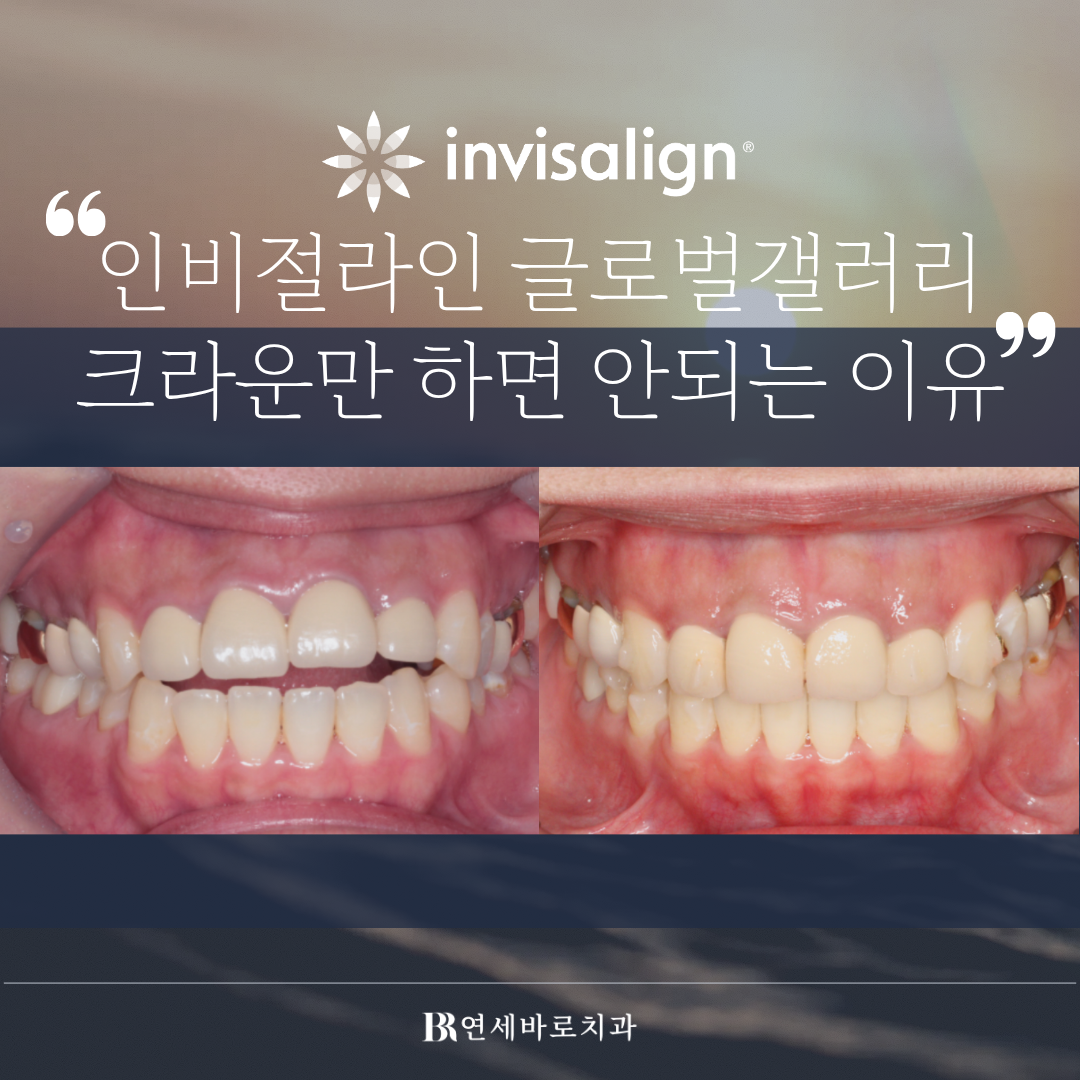 송도 인비절라인 글로벌 갤러리 : 크라운으로 개방교합 개선은 어렵습니다.