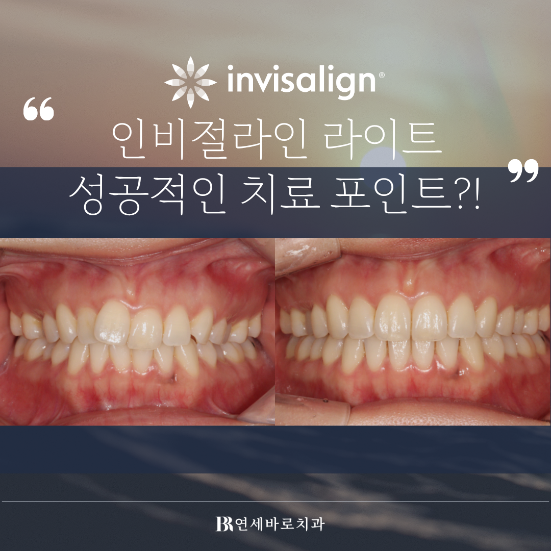 송도 인비절라인 라이트, 장치개수가 적은 만큼 OO이 중요합니다.