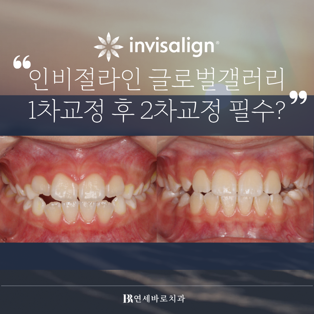 송도 인비절라인 : 1차 교정 후 2차 교정 꼭 해야 할까?