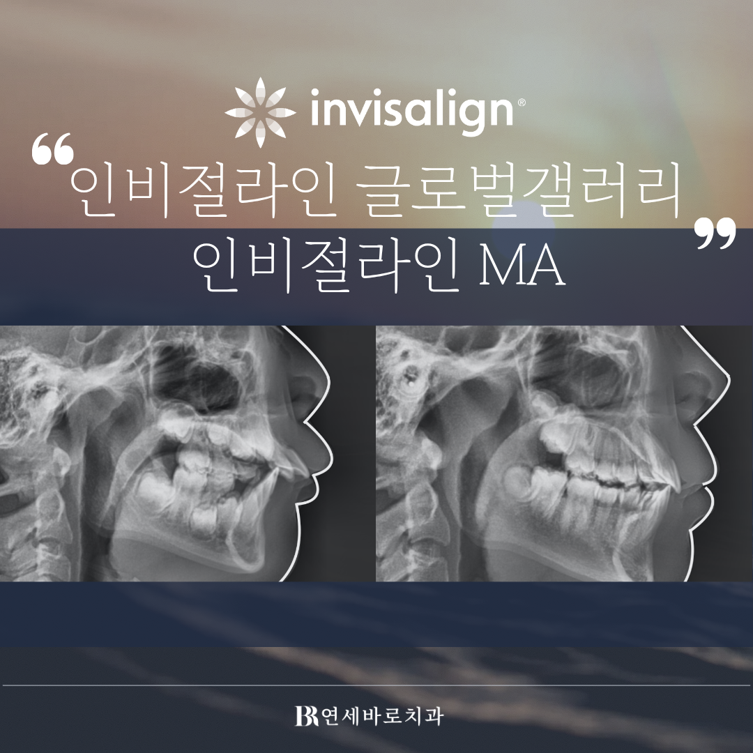 인천 어린이 교정치과 : 인비절라인 MA란?