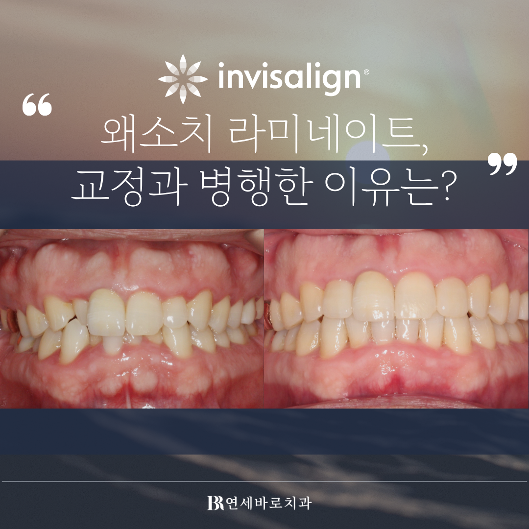 왜소치 교정 후 라미네이트 필요한 이유! : 인천 인비절라인 케이스